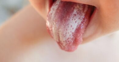 Muguet o candidiasis oral en bebés: síntomas y tratamientos