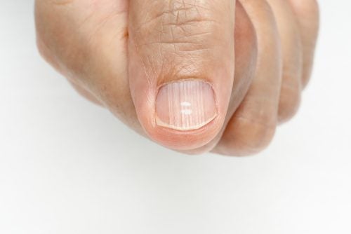 Por qué me salen líneas en las uñas y cómo eliminarlas?