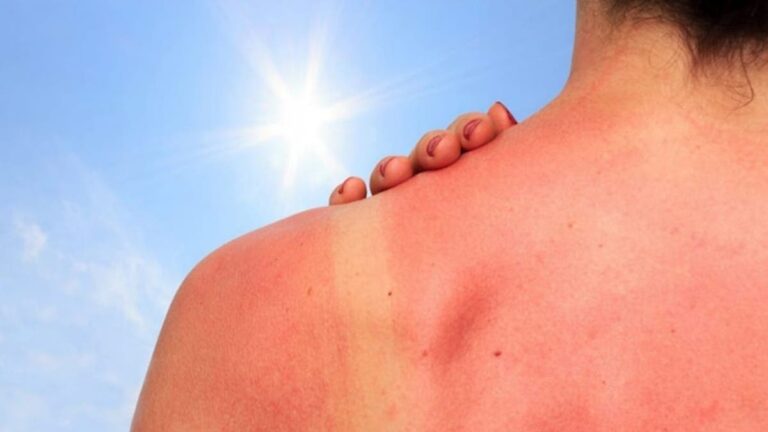 ¿Cómo tratar la piel quemada por el sol tras asueto
