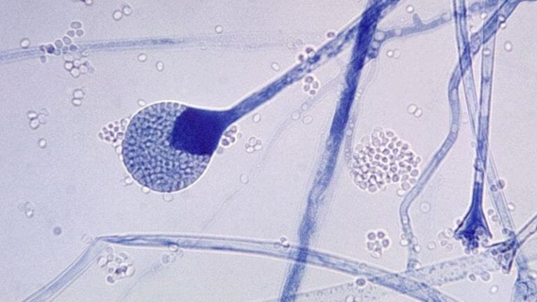 6 preguntas clave de la rara infección ataca a pacientes