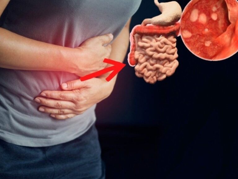 Colitis ulcerativa, condición sin síntomas propios y que se torna