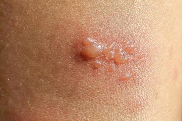 Penfigoide ampolloso: síntomas, causas y tratamiento