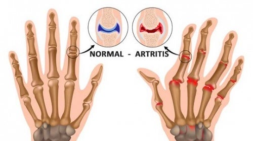 Cosas que probablemente no sabías de la artritis