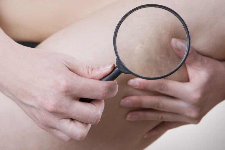 Recetas naturales sencillas para reducir la celulitis