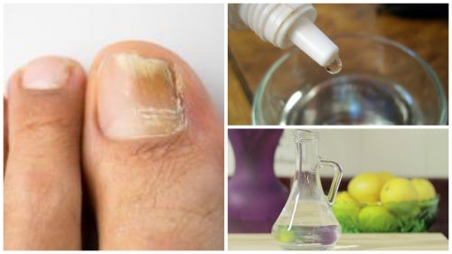 Fabrica tu propio rompehongos natural para las uñas