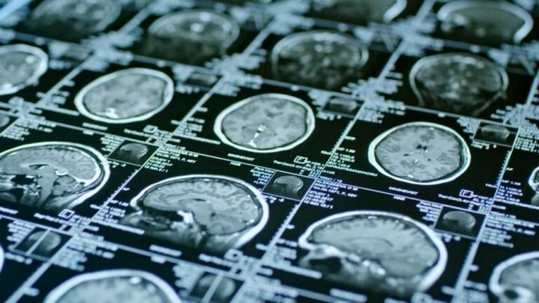 Por qué los científicos creen que el COVID-19 causa pérdida del tejido cerebral a largo plazo