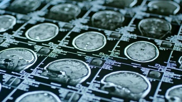 Los casos leves de COVID-19 también podrían acelerar el envejecimiento cerebral