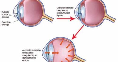 Glaucoma: cuándo ocurre y cómo evitarlo