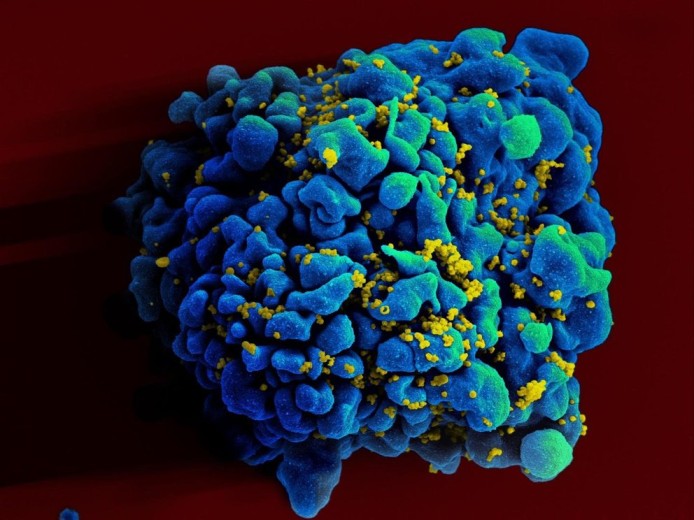 Una mujer argentina se habría curado de VIH por inmunidad natural
