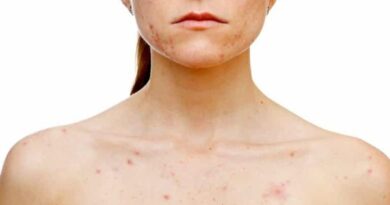 ¿Qué desencadena el acné en las mujeres?