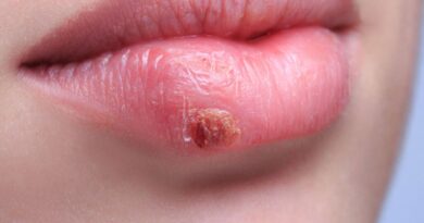 ¿Cómo diferenciar entre un grano y herpes labial?