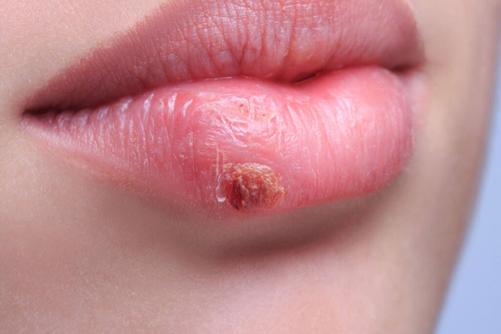 ¿Cómo diferenciar entre un grano y herpes labial?