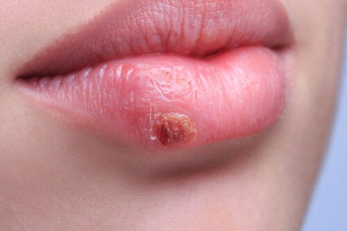 Cómo evitar y tratar la infección del herpes labial