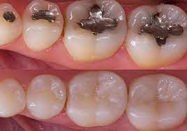 Resina dental o amalgama: ¿cuál es mejor?