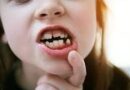 Muelas de los 6 años: primeros dientes permanentes en niños