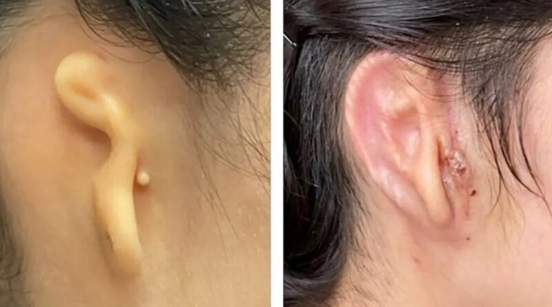 Reconstruyen oreja gracias a tejido humano impreso en 3D