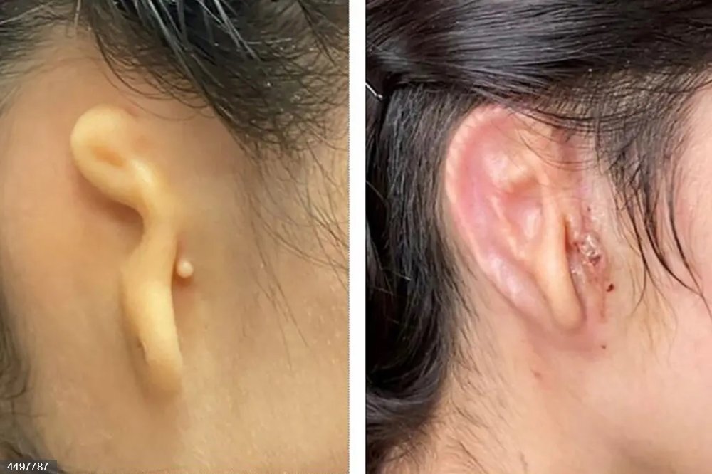 Reconstruyen oreja gracias a tejido humano impreso en 3D