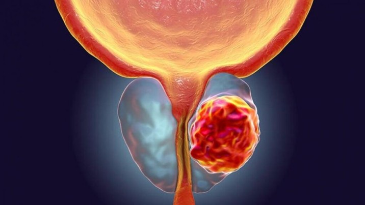 Día Mundial del Cáncer de Próstata; segundo más común en hombres