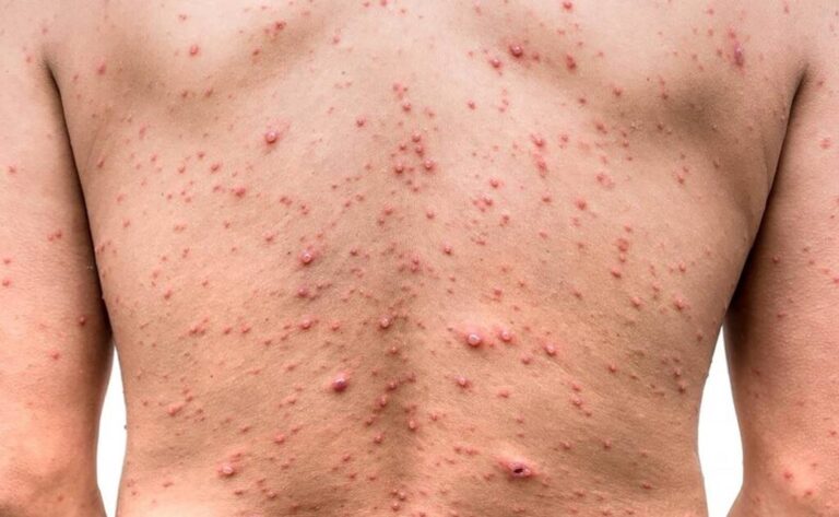 Casos emergentes de viruela del mono: expertos recomiendan el uso del cubrebocas