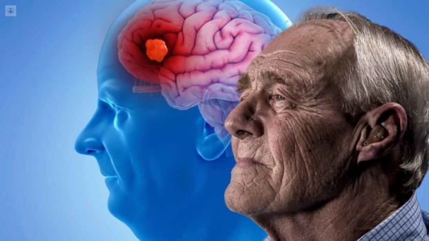 Dos medicamentos ya aprobados frenan síntomas del Alzheimer