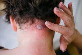 Tipos de dermatitis y sus principales características