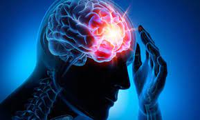 Trombosis arterial cerebral: qué es, causas, síntomas y tratamiento