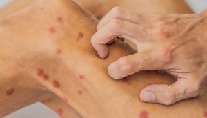 Reportan más de 200 casos de lepra en el país