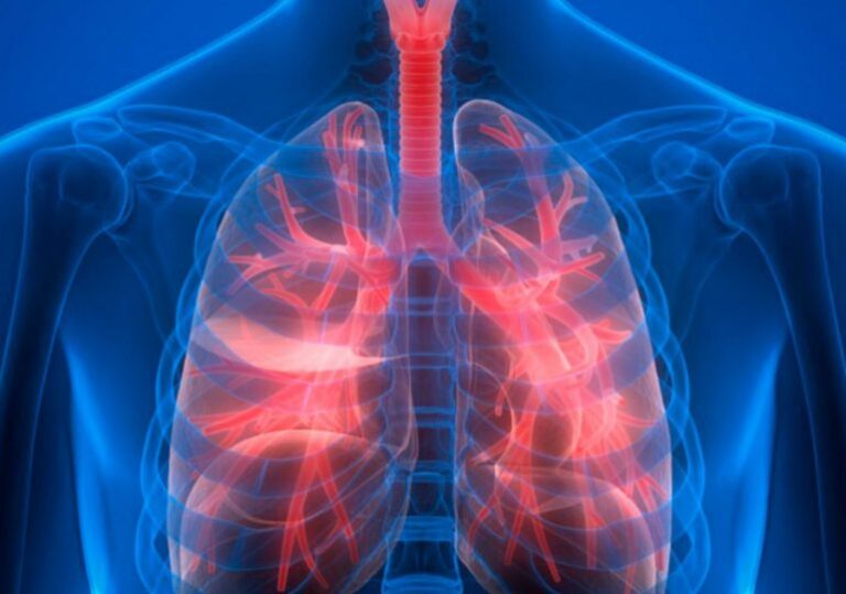 Más de 65 millones de personas sufren de enfermedad pulmonar obstructiva crónica