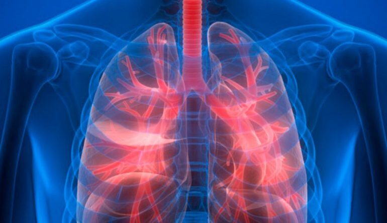 Más de 65 millones de personas sufren de enfermedad pulmonar obstructiva crónica