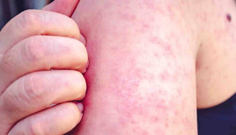 Confirman tres casos nuevos casos de viruela del mono en el país