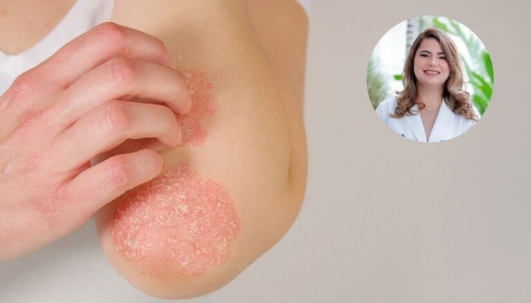 Día Mundial de la Psoriasis ¿Qué es?