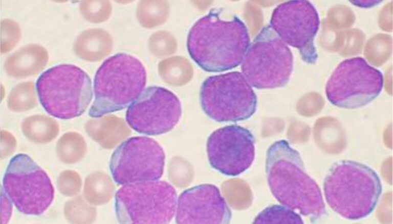 Descubren rol de proteína clave en el desarrollo leucemia mielogénica crónica