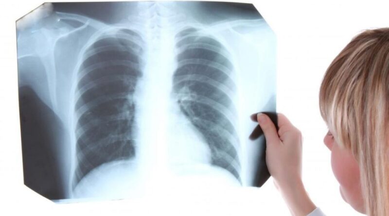 Aumenta morbimortalidad por tuberculosis durante pandemia