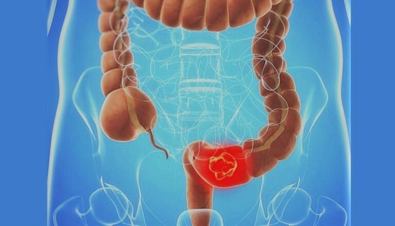 Descifran más de 100 genes relacionados con riesgo cáncer colorrectal