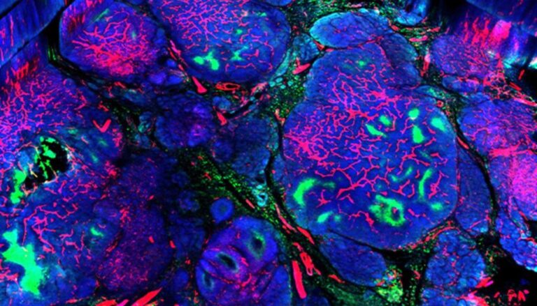 Demuestran eficiencia nuevo tratamiento para cáncer de mama