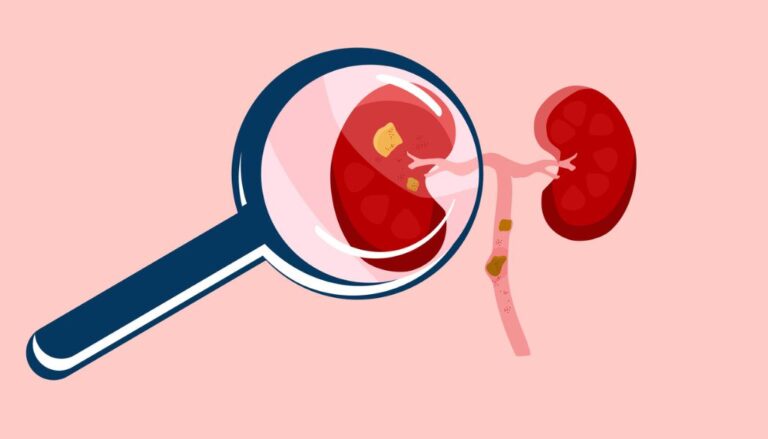 Alertan 1 de cada 10 adultos padece enfermedad renal crónica