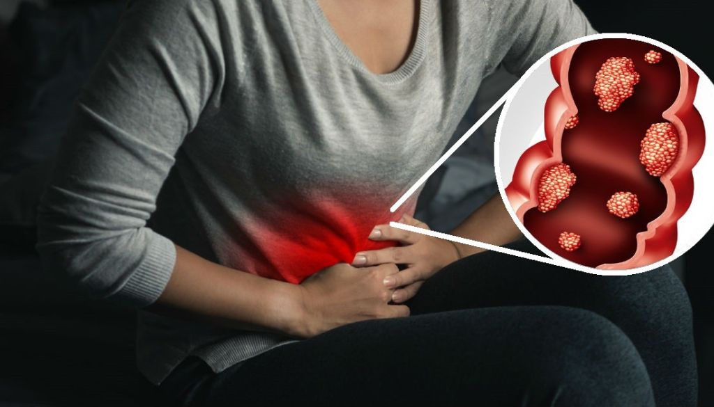 Advierten mujeres son las más diagnosticadas con cáncer de colon