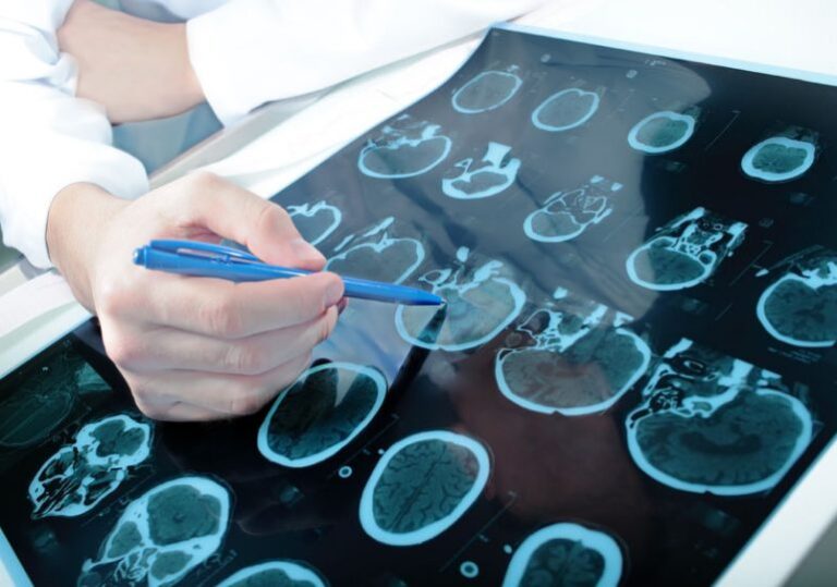 Avance prometedor para el diagnóstico de la enfermedad de Parkinson