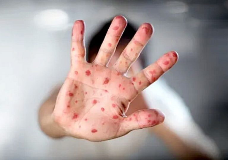 OMS levanta la alerta máxima mundial por epidemia de la viruela del mono