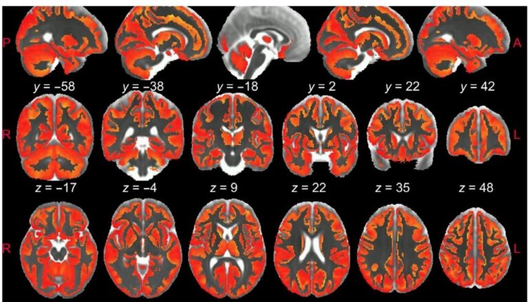 Nuevo estudio demuestra la seguridad de la introducción de terapia génica en regiones específicas del cerebro