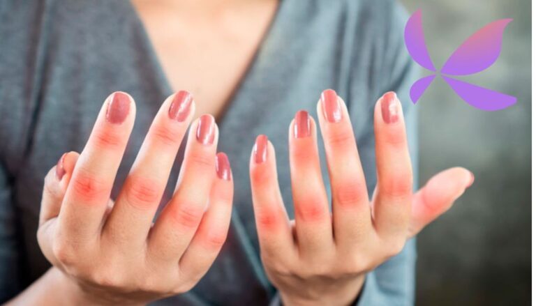 90% personas que viven con lupus son mujeres