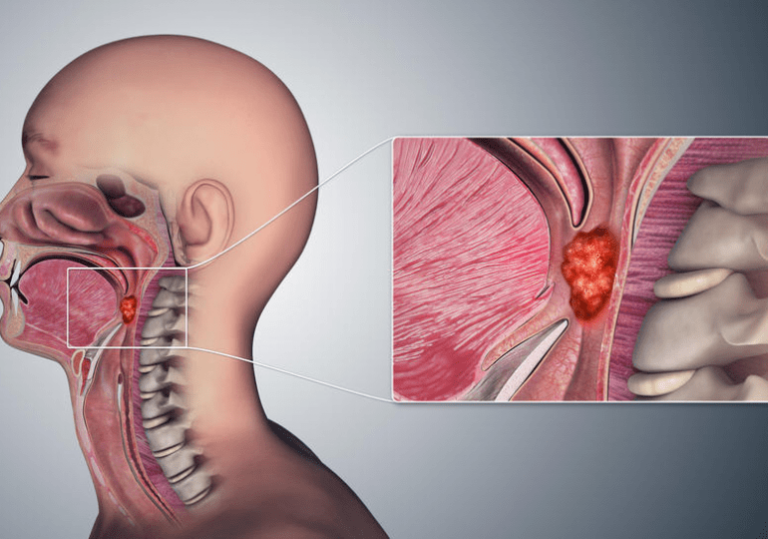 La infección por el VPH puede causar cáncer de boca y de garganta