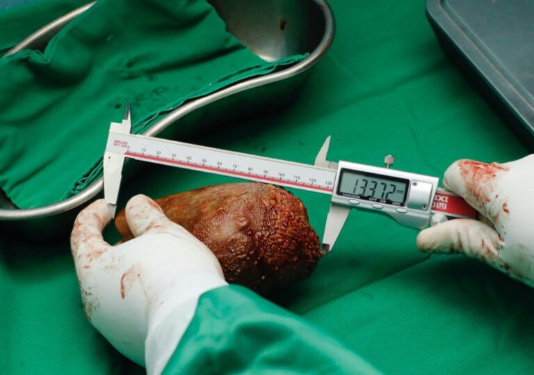Extirpan a un hombre el "cálculo renal más grande del mundo"