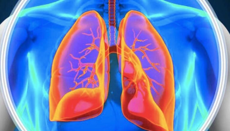 Expertos en hipertensión pulmonar piden ampliar los parámetros de diagnóstico