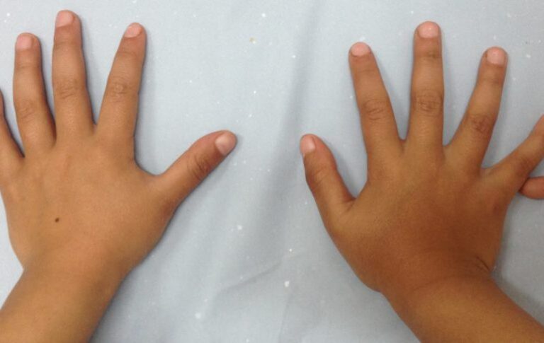 Anuncian amplia jornada médica en favor de niños que padecen malformación congénita de Polidactilia