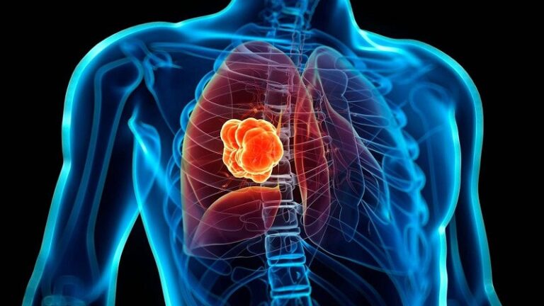 El cáncer de pulmón mataría más de 160.000 latinos en una década