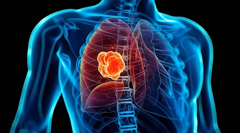 El cáncer de pulmón mataría más de 160.000 latinos en una década