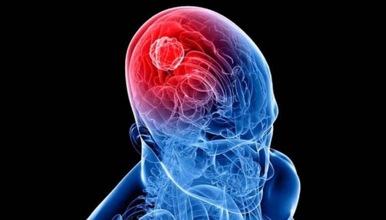 Estudio descubre tumores cerebrales ‘hackean’ la comunicación entre las neuronas