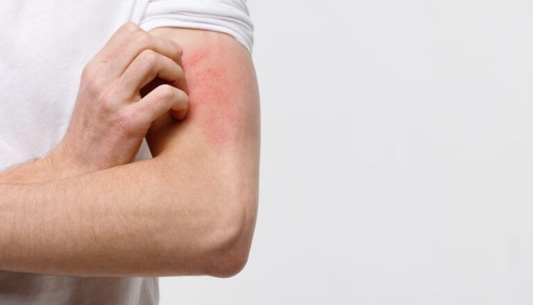 País dispone de nuevo tratamiento para dermatitis atópica en adultos