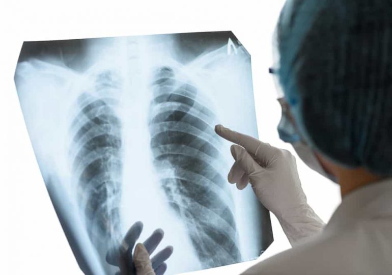 Diagnóstico temprano y avances significativos en tratamiento podrían reducir alta tasa de mortalidad de cáncer de pulmón